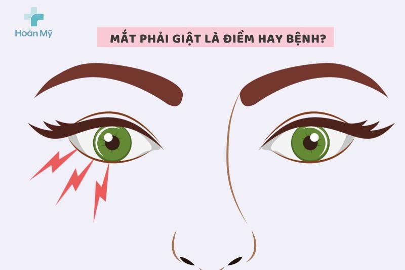 Giật mắt phải ở nữ do căng thẳng